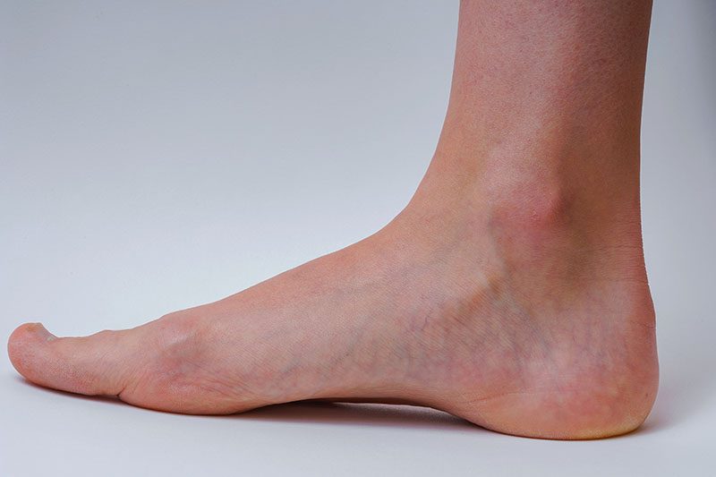 Ankle Varicose Veins Kew, Foot Varicose Veins